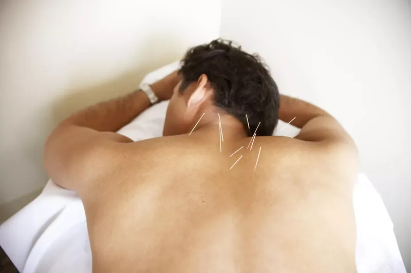 Acupuncture on man's back